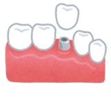 teeth_implant_コピー